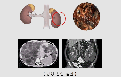 낭성신장질환 엑스레이사진