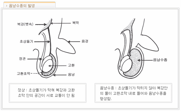 소아 음낭수종의 발생