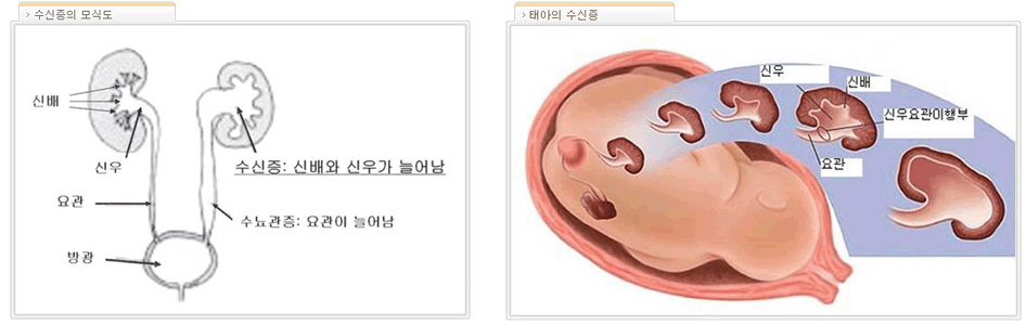 수진증의 모식도와 태야의 수신증사진