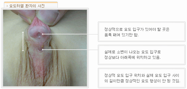 요도하열 소아 환자의 사진