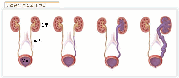 방광요관역류의 모식적인 사진