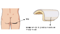 자가진피 확대술 순서 