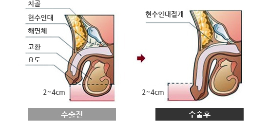 현수인대 차단술