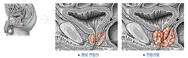 정상 전립선과 전립선암의 모양