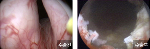 왼쪽 전리비선 비대증 수술전과 오른쪽 비대증 수술후 사진