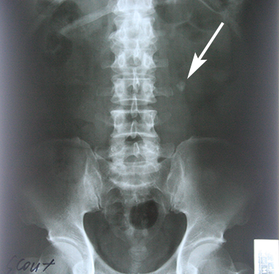 요로결석 X-ray사진