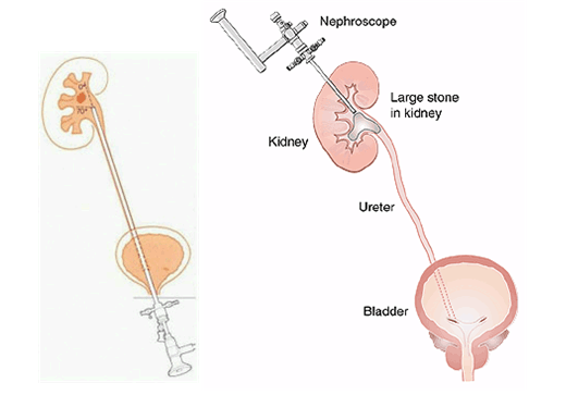 요로결석수술부위