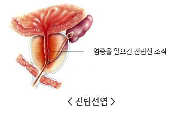 전립선염모양